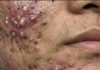 Big Cystic Acne Blackheads Extraction