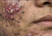 Big Cystic Acne Blackheads Extraction