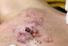 Cystic Acne Blackheads Extraction