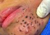 Cystic Acne Blackheads Extraction