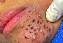 Cystic Acne Blackheads Extraction