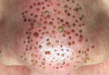 Blackheads Extraction