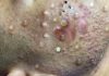 Cystic Acne Extraction Whiteheads