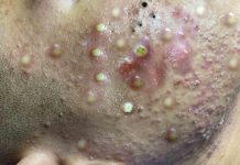 Cystic Acne Extraction Whiteheads