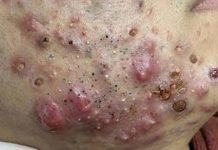 Blackheads Extraction