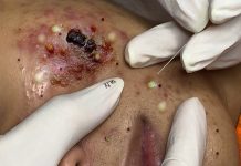 Acne Blackheads Extraction Removal