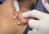 Big Cystic Blackheads Extraction Whiteheads