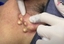 Big Cystic Blackheads Extraction Whiteheads