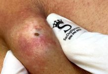 Big Cystic Blackheads Extraction