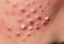 Cystic Acne Blackheads Extraction Whiteheads