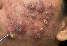 Acne Blackheads Extraction