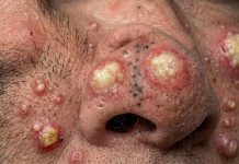 Cystic Extraction Whiteheads