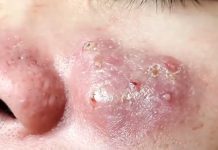 Cystic Acne Blackheads Extraction