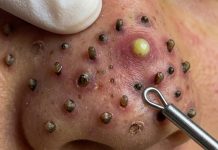 Cystic Acne Blackheads Extraction Whiteheads