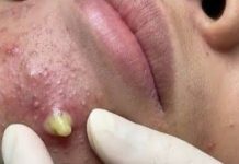 Big Cystic Whiteheads