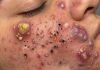 Big Cystic Acne Blackheads Extraction