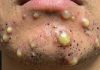 Big Cystic Blackheads Extraction Whiteheads