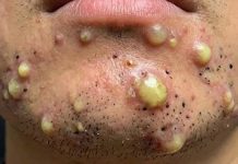 Big Cystic Blackheads Extraction Whiteheads