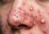 Cystic Extraction Whiteheads