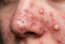 Cystic Extraction Whiteheads