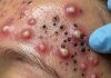 Blackheads Extraction Whiteheads