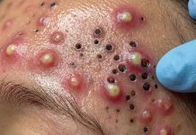 Blackheads Extraction Whiteheads