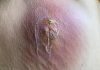 Blackheads Extraction Blackheads