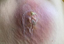 Blackheads Extraction Blackheads