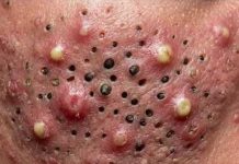 Blackheads Extraction Blackheads