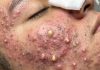 Cystic Acne Extraction Blackheads