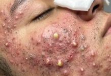 Cystic Acne Extraction Blackheads