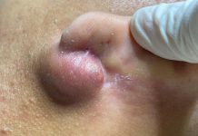 Big Blackheads Extraction