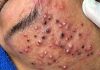 Acne Blackheads Extraction
