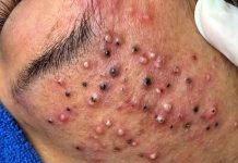 Acne Blackheads Extraction