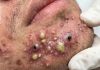 Big Cystic Blackheads Extraction