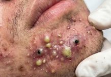 Big Cystic Blackheads Extraction
