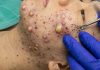Cystic Acne Blackheads Extraction Whiteheads