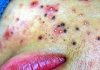 Acne Blackheads Extraction Blackheads