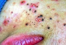 Acne Blackheads Extraction Blackheads