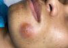 Acne Blackheads Extraction