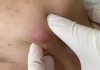 Blackheads Extraction