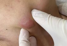 Blackheads Extraction