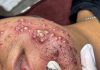 Cystic Acne Blackheads Extraction Whiteheads