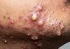 Blackheads Extraction Whiteheads