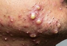 Blackheads Extraction Whiteheads
