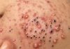 Acne Blackheads Extraction
