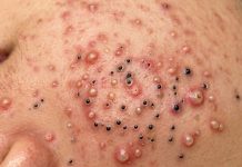 Acne Blackheads Extraction