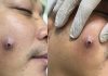 Blackheads Extraction