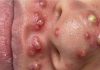 Blackheads Extraction Whiteheads