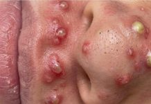 Blackheads Extraction Whiteheads